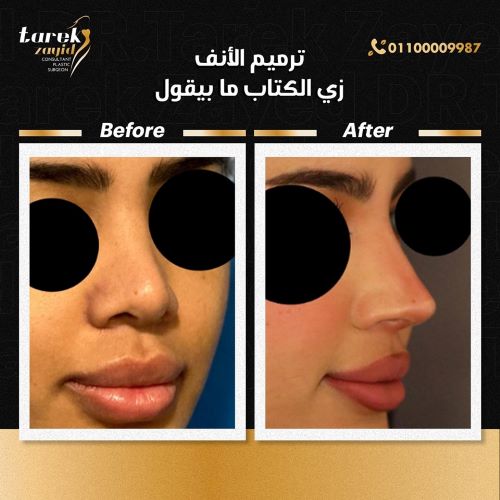 متى تظهر نتائج عمليات تجميل الانف